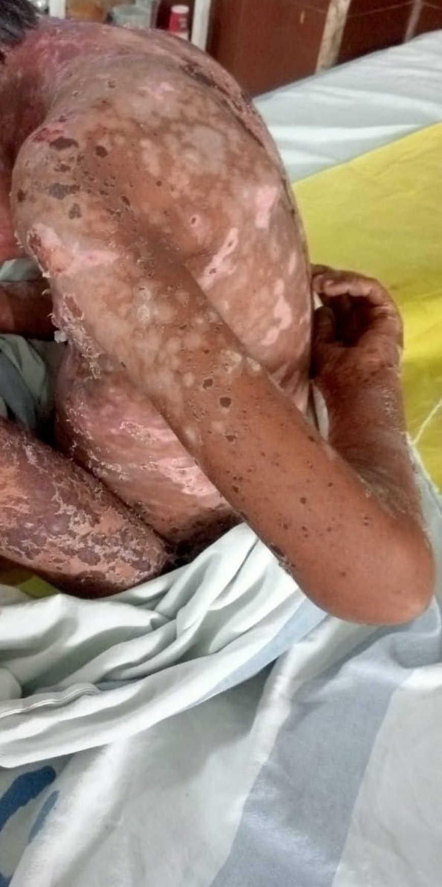 स्वास्थ्य विभाग की खुली पोल,5 वर्षीया मासूम को हुआ दवा का रिएक्शन, निकले शरीर में बड़े बड़े फोड़े