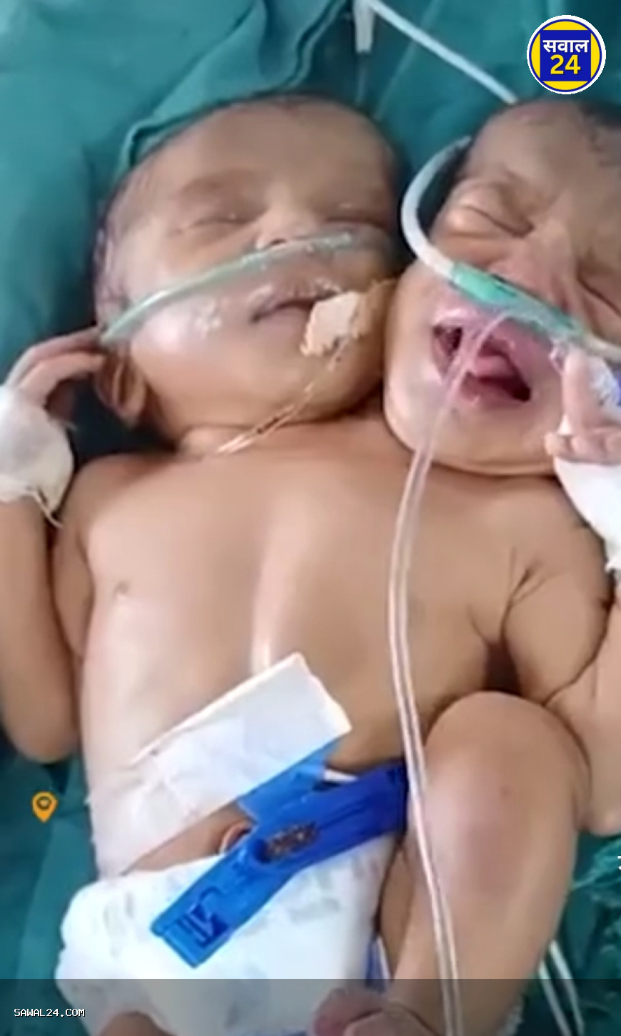 दो सिर वाली बच्ची का जन्म बना चर्चा का विषय, डॉक्टरों के सामने मेडिकल चमत्कार जैसी चुनौती